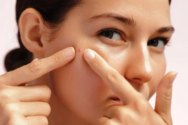 Jerawat Bandel? Simak 5 Cara Ampuh Mengatasinya Tanpa Iritasi